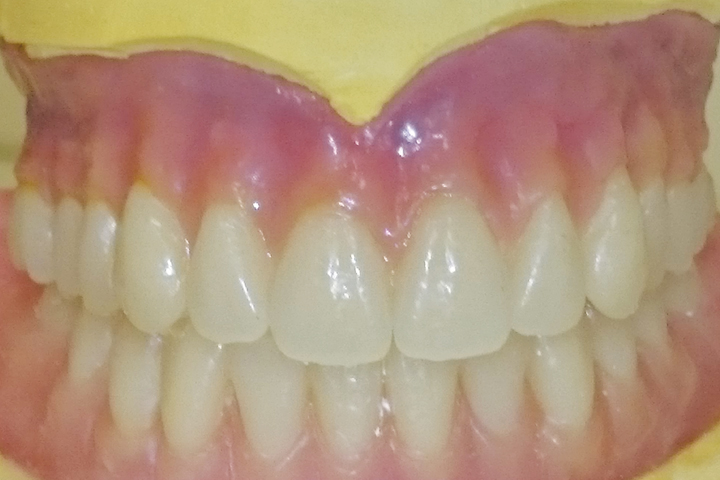 Full Upper And Lower Dentures