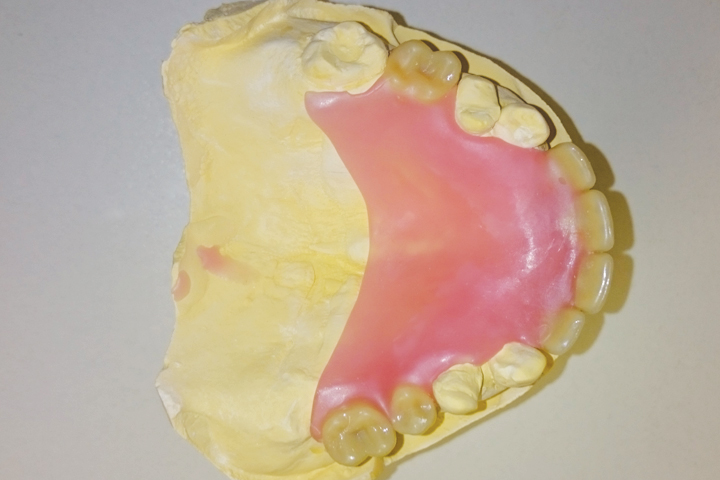 acrylic partial dentures