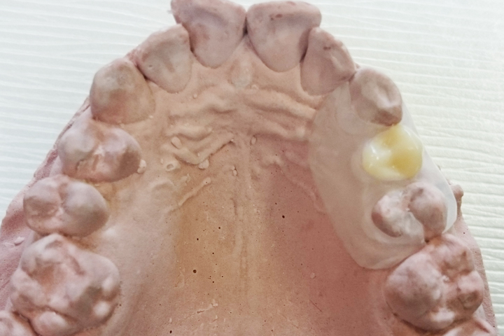 Implant Retained Dentures