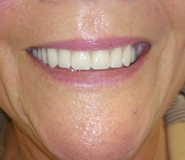 Ultra Stable Lower Dentures