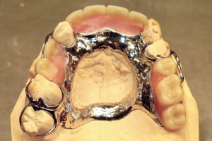 Chrome Dentures Available At Cavan Denture Clinic Chrome Dentures Available At Cavan Denture Clinic